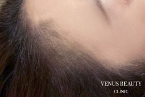 ヘアアートメイク症例一覧 施術後