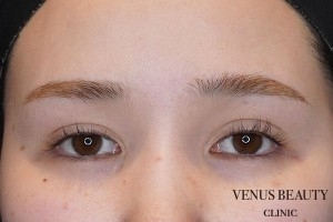 眼瞼下垂症 施術前