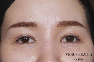 眼瞼下垂症 施術後