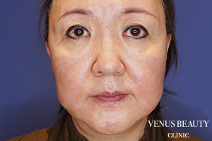 フルフェイスリフト 施術後