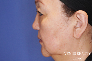 フルフェイスリフト 施術前