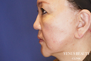 フルフェイスリフト 施術後