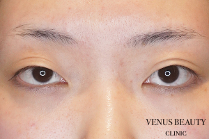 目頭切開 施術前