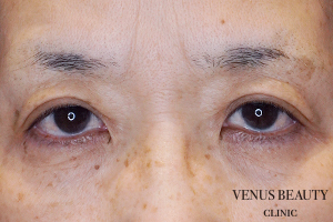 下まぶたのたるみとり 施術前