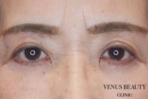 下まぶたのたるみとり 施術後