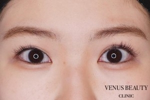 二重まぶた全切開法 施術後