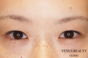 二重まぶた全切開法 施術前