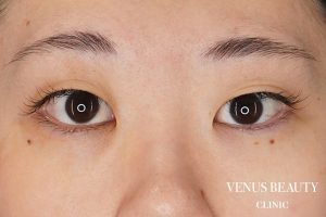 目頭切開 施術前