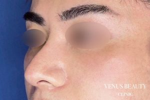 わし鼻・段鼻修正 ハンプ切除 施術後