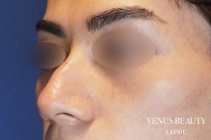 わし鼻・段鼻修正 ハンプ切除 施術前