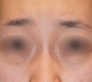 下まぶたのたるみとり 施術前