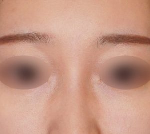 下まぶたのたるみとり 施術後