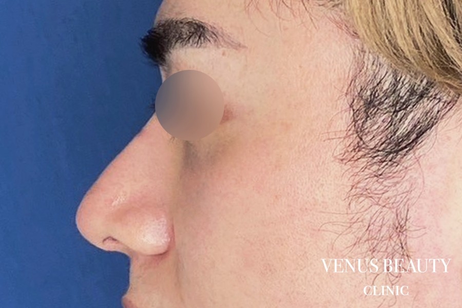 わし鼻・段鼻修正 ハンプ切除 施術後