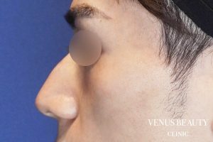 わし鼻・段鼻修正 ハンプ切除 施術前