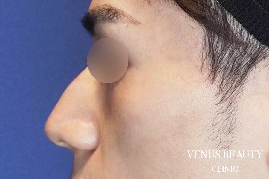 わし鼻・段鼻修正 ハンプ切除 施術前