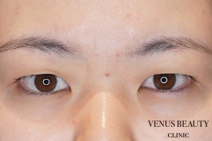 二重まぶた全切開法 施術前