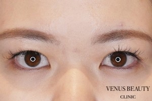 二重まぶた全切開法 施術後