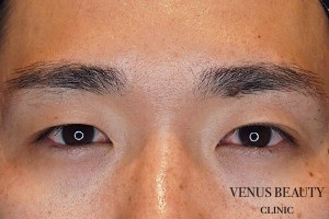 二重まぶた全切開法 施術前