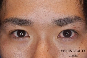 二重まぶた全切開法 施術後