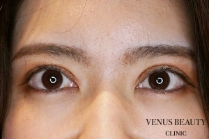 二重まぶた全切開法 施術後