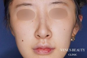 骨切幅寄せ 施術後