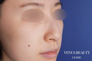 わし鼻・段鼻修正 ハンプ切除 施術前