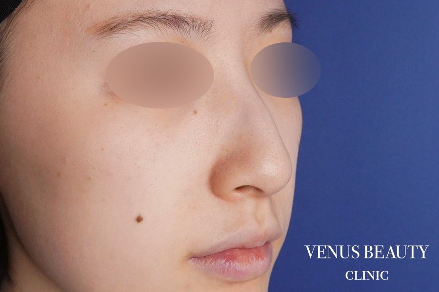 わし鼻・段鼻修正 ハンプ切除 施術前