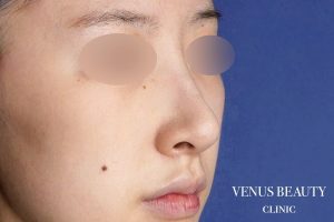 わし鼻・段鼻修正 ハンプ切除 施術後