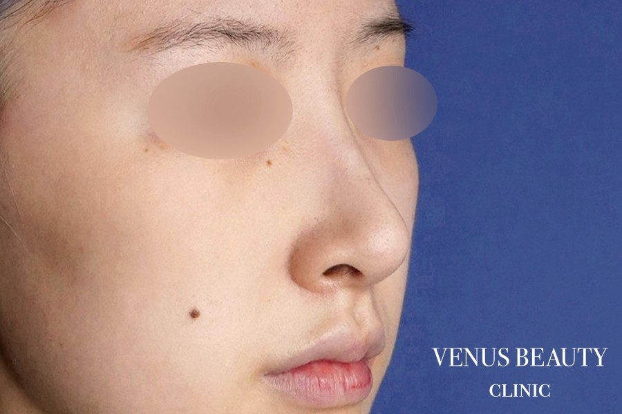 わし鼻・段鼻修正 ハンプ切除 施術後