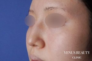 わし鼻・段鼻修正 ハンプ切除 施術前