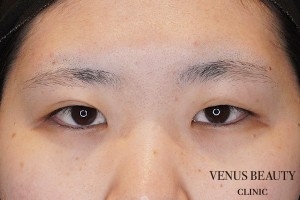 二重まぶた全切開法 施術前