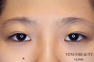 目尻切開 施術前