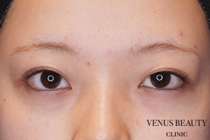 二重まぶた全切開法 施術前