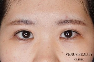 二重まぶた全切開法 施術後