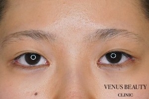 目尻切開 施術後