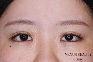 目頭切開 施術後