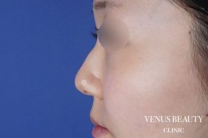 鼻中隔延長 施術前