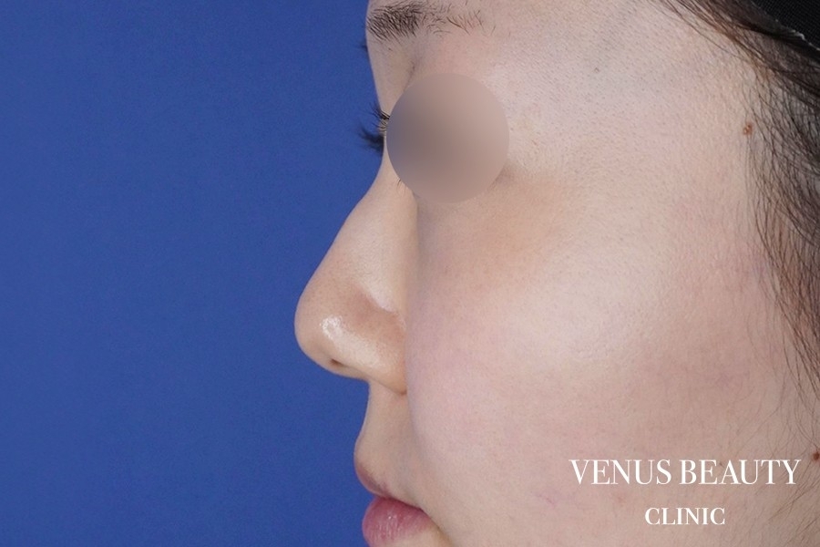 わし鼻・段鼻修正 ハンプ切除 施術前