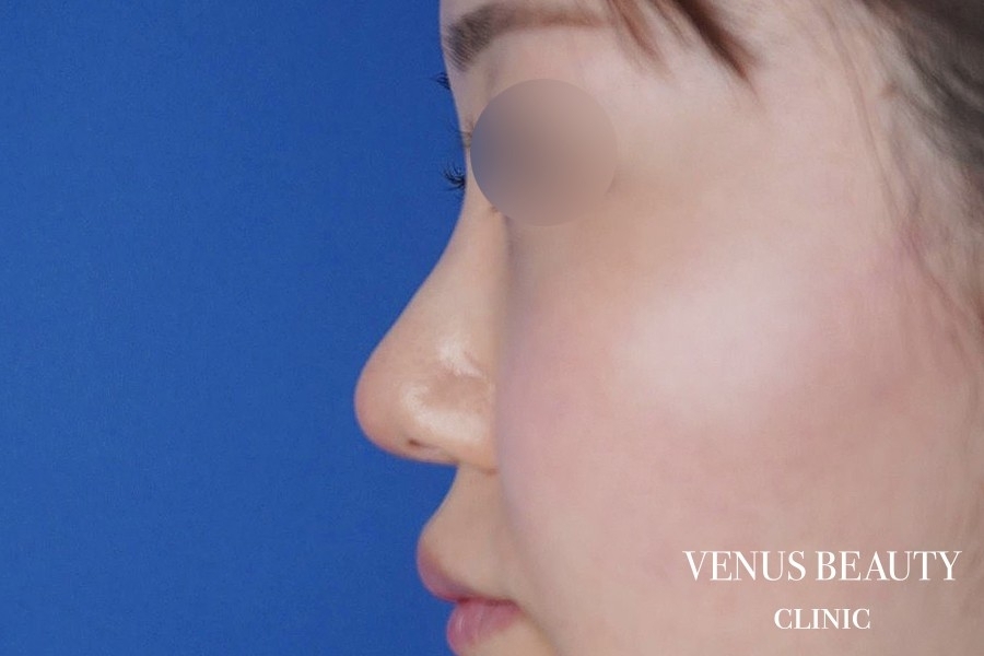 わし鼻・段鼻修正 ハンプ切除 施術後