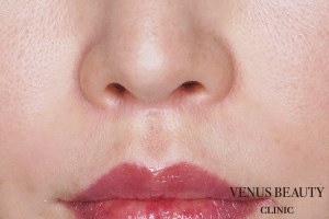 人中短縮術 施術後