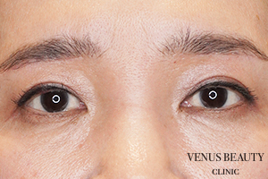 眉下切開(眉下リフト) 施術後