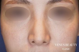 骨切幅寄せ 施術後