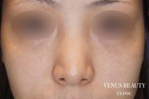 骨切幅寄せ 施術前