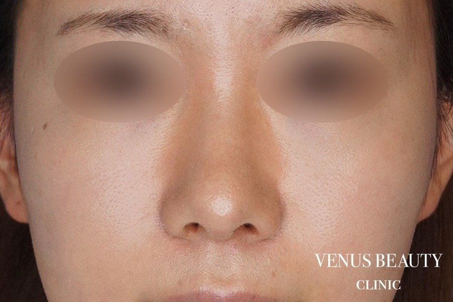 鼻中隔延長 施術後