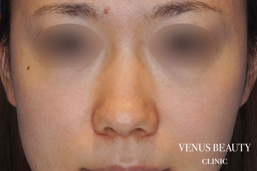 鼻中隔延長 施術前