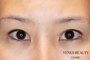 下瞼開大術（グラマラスライン） 施術前