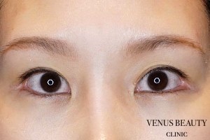 下瞼開大術（グラマラスライン） 施術後