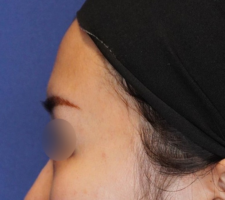 脂肪注入 施術前