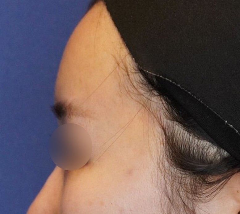 脂肪注入 施術後