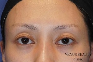 眼瞼下垂症 施術前